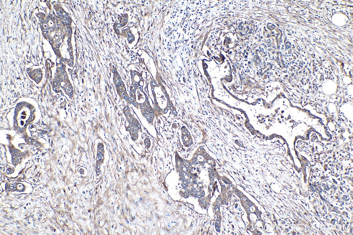 IHC staining of human pancreas cancer using 28543-1-AP