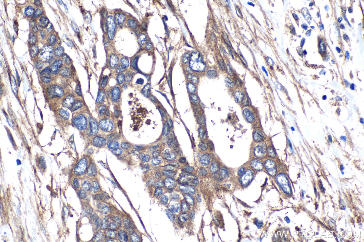 IHC staining of human pancreas cancer using 28543-1-AP