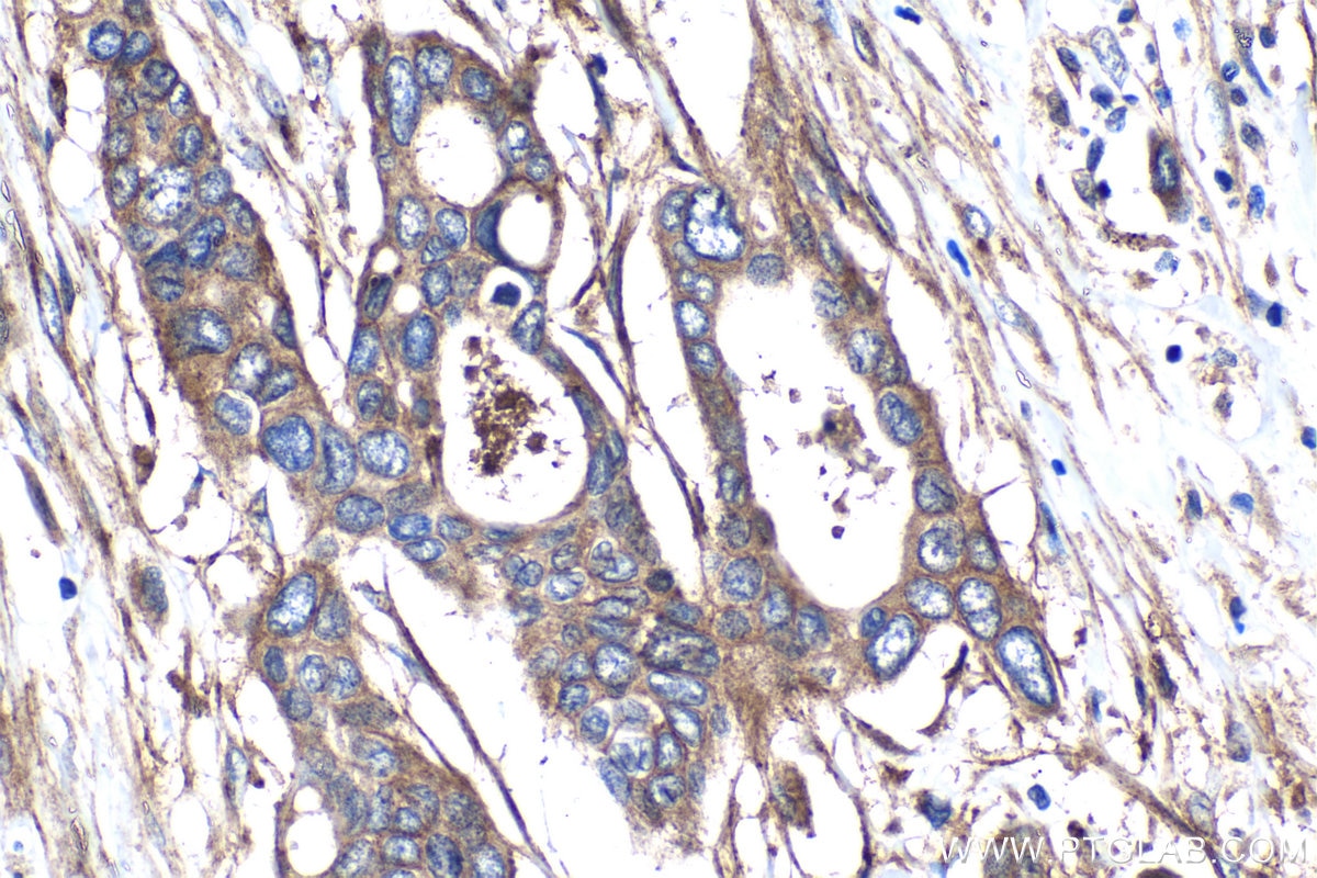 Immunohistochemistry (IHC) staining of human pancreas cancer tissue using Integrin Beta 5 Polyclonal antibody (28543-1-AP)