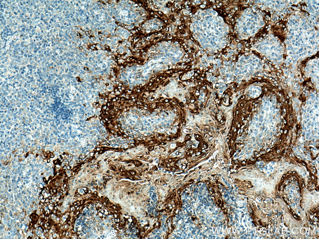 Immunohistochemistry (IHC) staining of human tonsillitis tissue using Involucrin Polyclonal antibody (28462-1-AP)