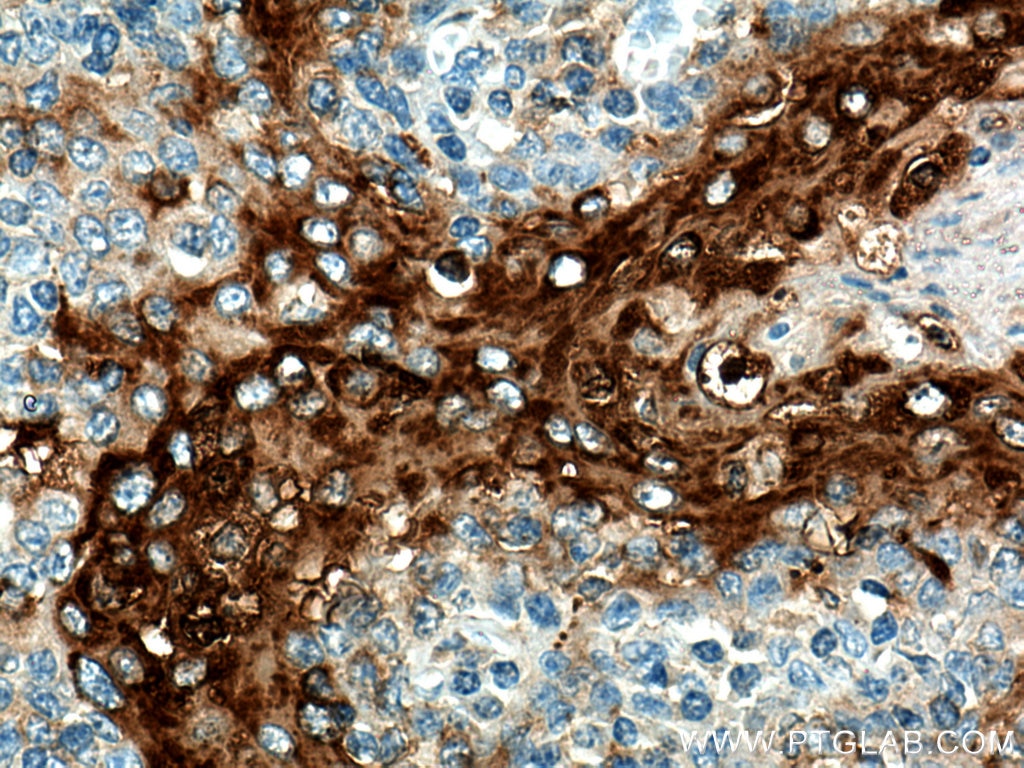 IHC staining of human tonsillitis using 28462-1-AP