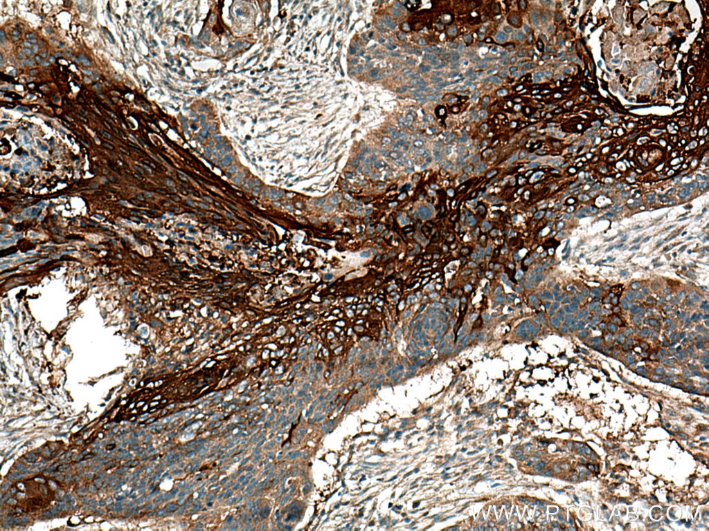 Immunohistochemistry (IHC) staining of human oesophagus cancer tissue using Involucrin Polyclonal antibody (28462-1-AP)