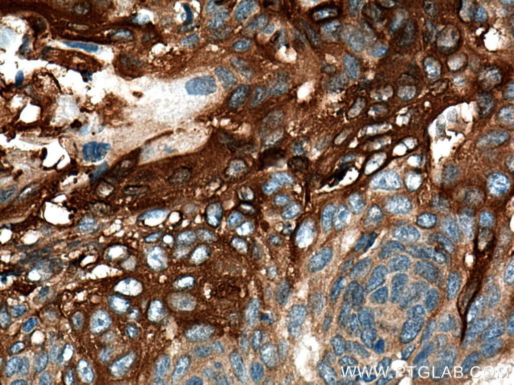 Immunohistochemistry (IHC) staining of human oesophagus cancer tissue using Involucrin Polyclonal antibody (28462-1-AP)