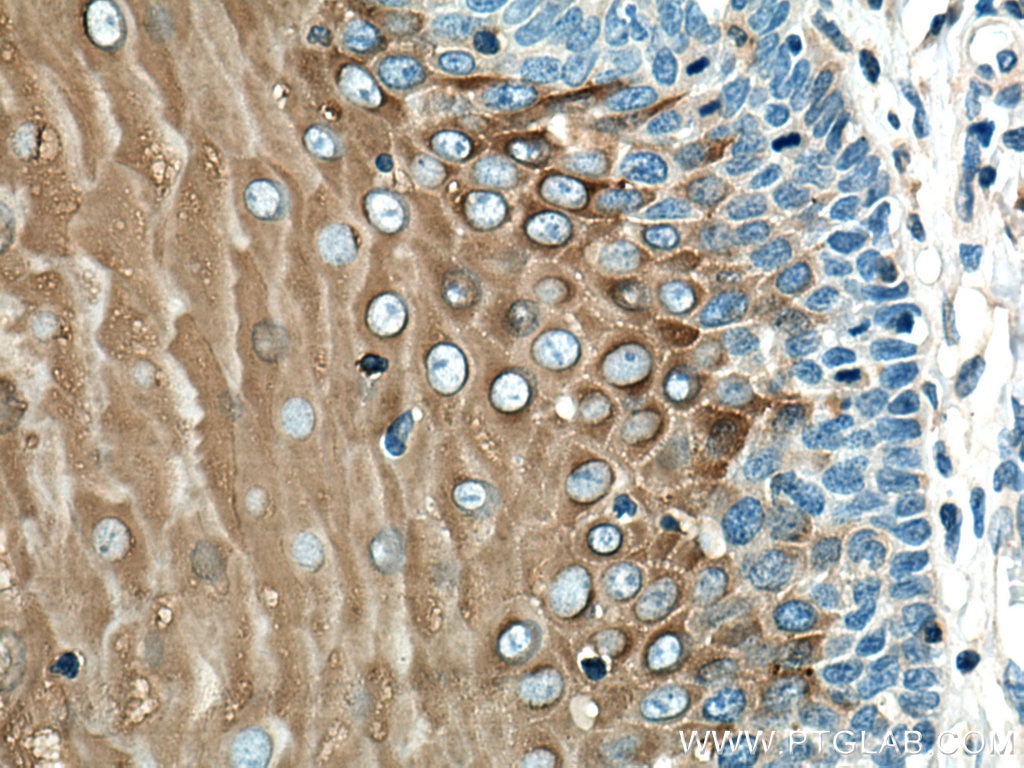Immunohistochemistry (IHC) staining of human oesophagus cancer tissue using Involucrin Polyclonal antibody (28462-1-AP)