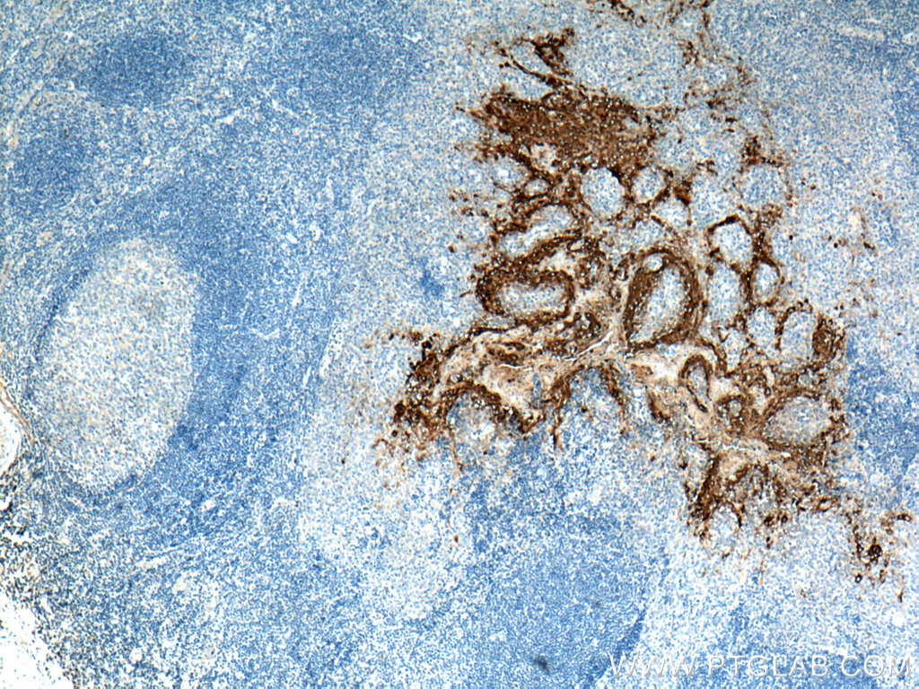 Immunohistochemistry (IHC) staining of human tonsillitis tissue using Involucrin Polyclonal antibody (28462-1-AP)