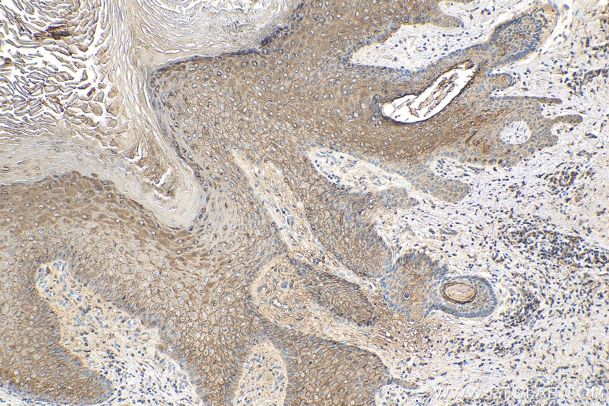 Immunohistochemistry (IHC) staining of human skin cancer tissue using Involucrin Polyclonal antibody (28462-1-AP)