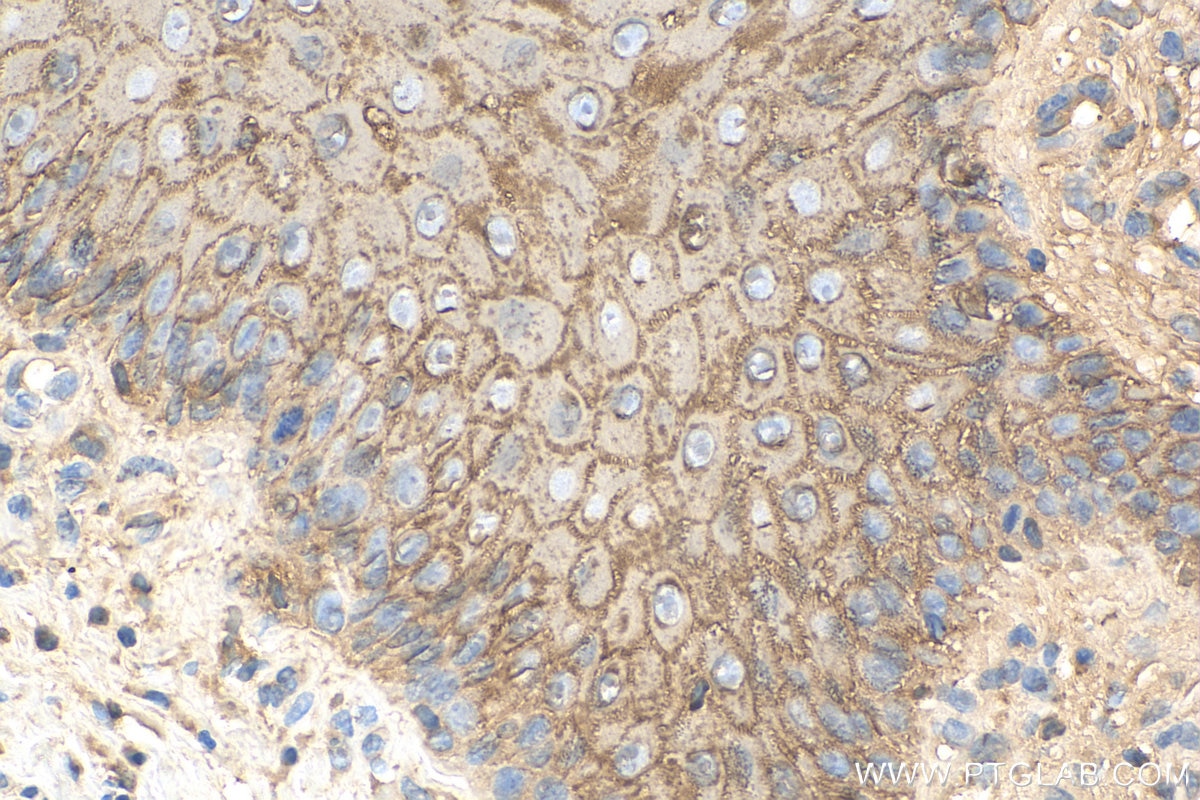 Immunohistochemistry (IHC) staining of human skin cancer tissue using Involucrin Polyclonal antibody (28462-1-AP)