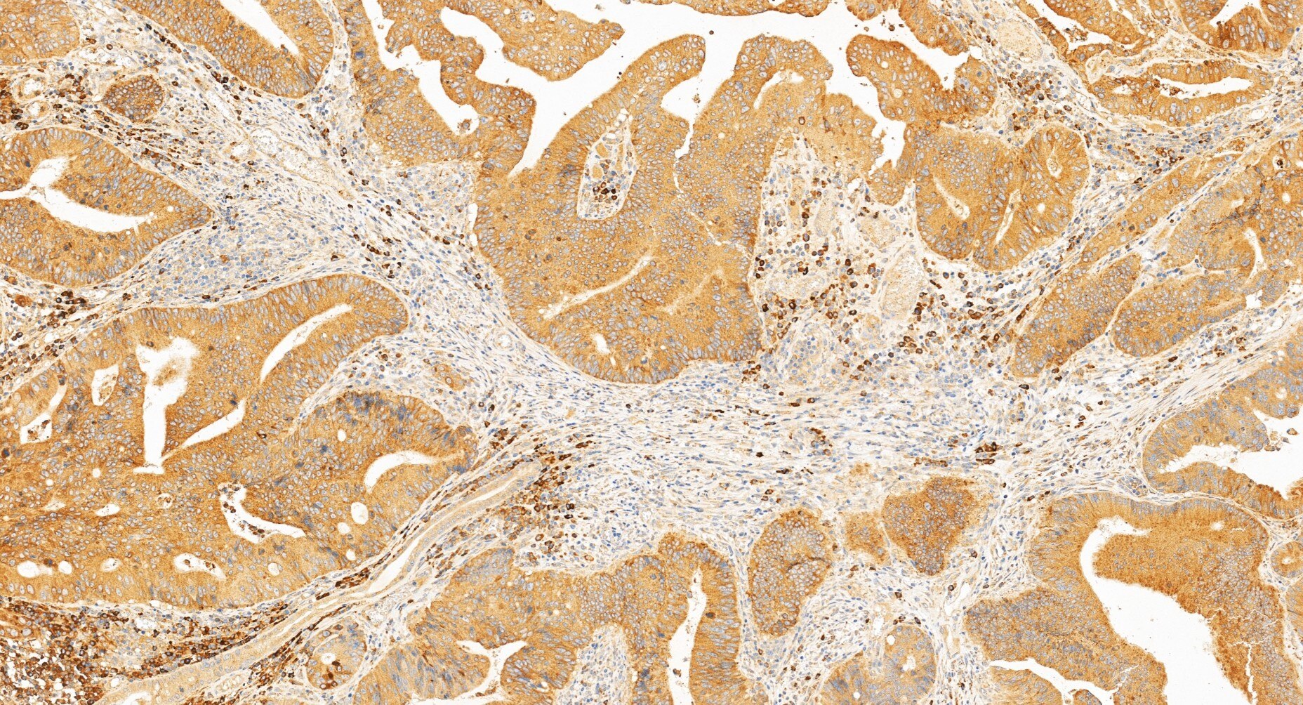Immunohistochemistry (IHC) staining of human colon cancer tissue using JAGN1 Polyclonal antibody (34193-1-AP)