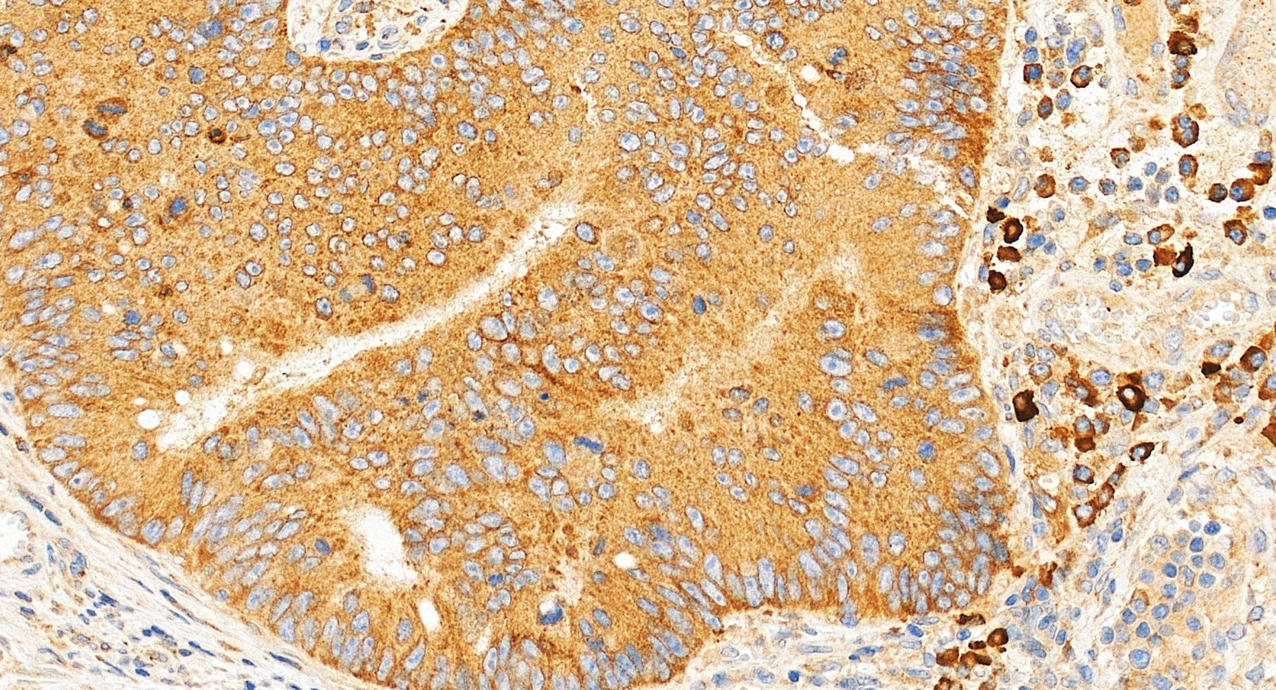 Immunohistochemistry (IHC) staining of human colon cancer tissue using JAGN1 Polyclonal antibody (34193-1-AP)