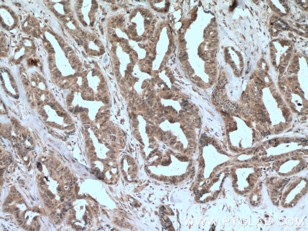 Immunohistochemistry (IHC) staining of human breast cancer tissue using JAK1 Monoclonal antibody (66466-1-Ig)