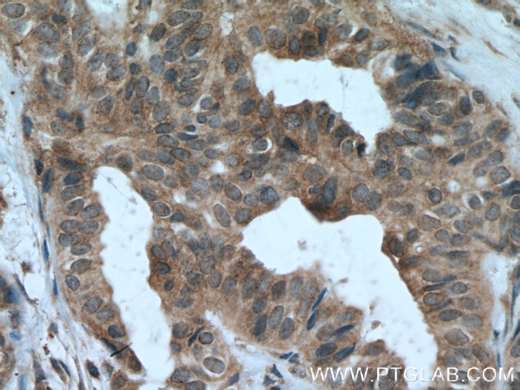 Immunohistochemistry (IHC) staining of human breast cancer tissue using JAK1 Monoclonal antibody (66466-1-Ig)
