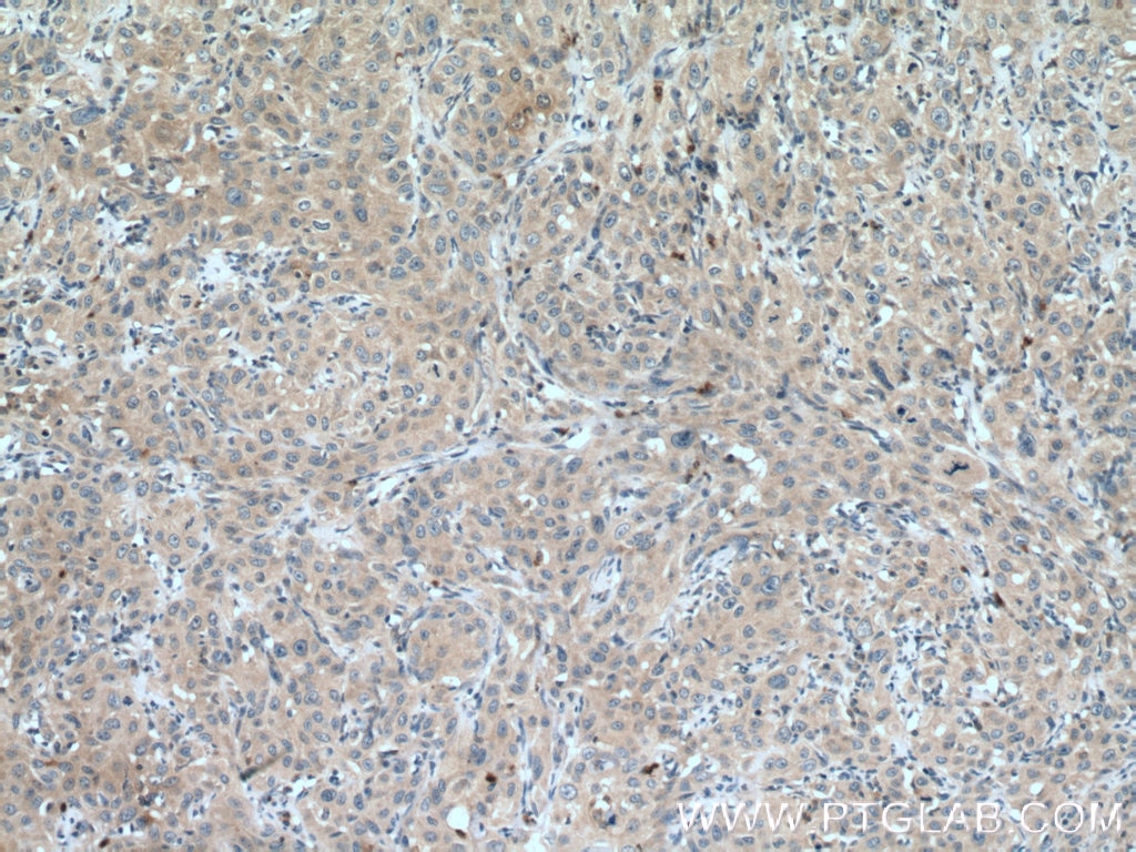 Immunohistochemistry (IHC) staining of human cervical cancer tissue using JAK1 Monoclonal antibody (66466-1-Ig)