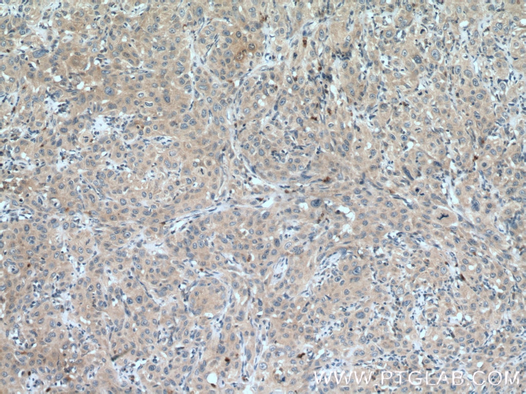 IHC staining of human cervical cancer using 66466-1-Ig