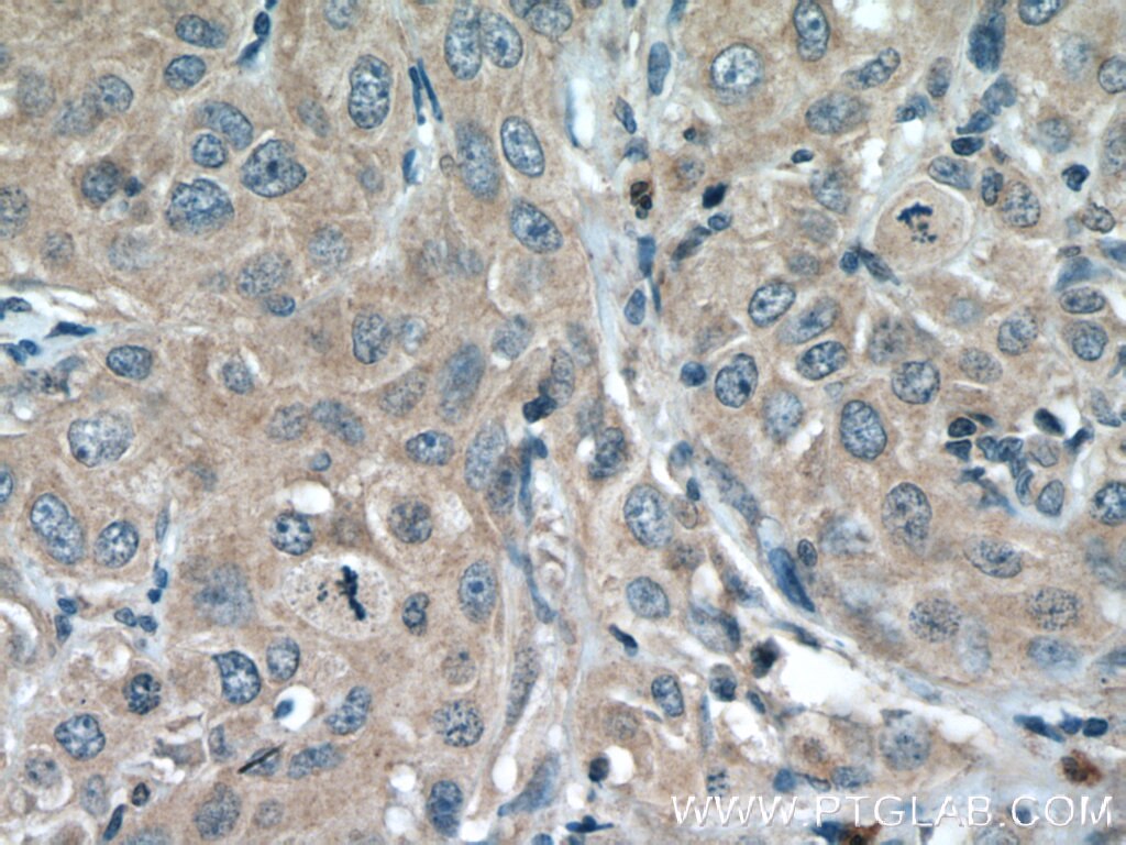 IHC staining of human cervical cancer using 66466-1-Ig