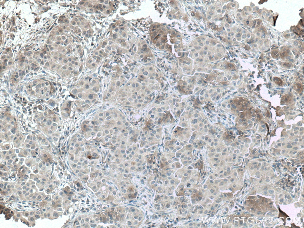 Immunohistochemistry (IHC) staining of human breast cancer tissue using JAK2 Polyclonal antibody (17670-1-AP)