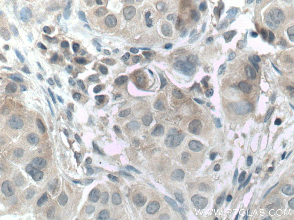 Immunohistochemistry (IHC) staining of human breast cancer tissue using JAK2 Polyclonal antibody (17670-1-AP)