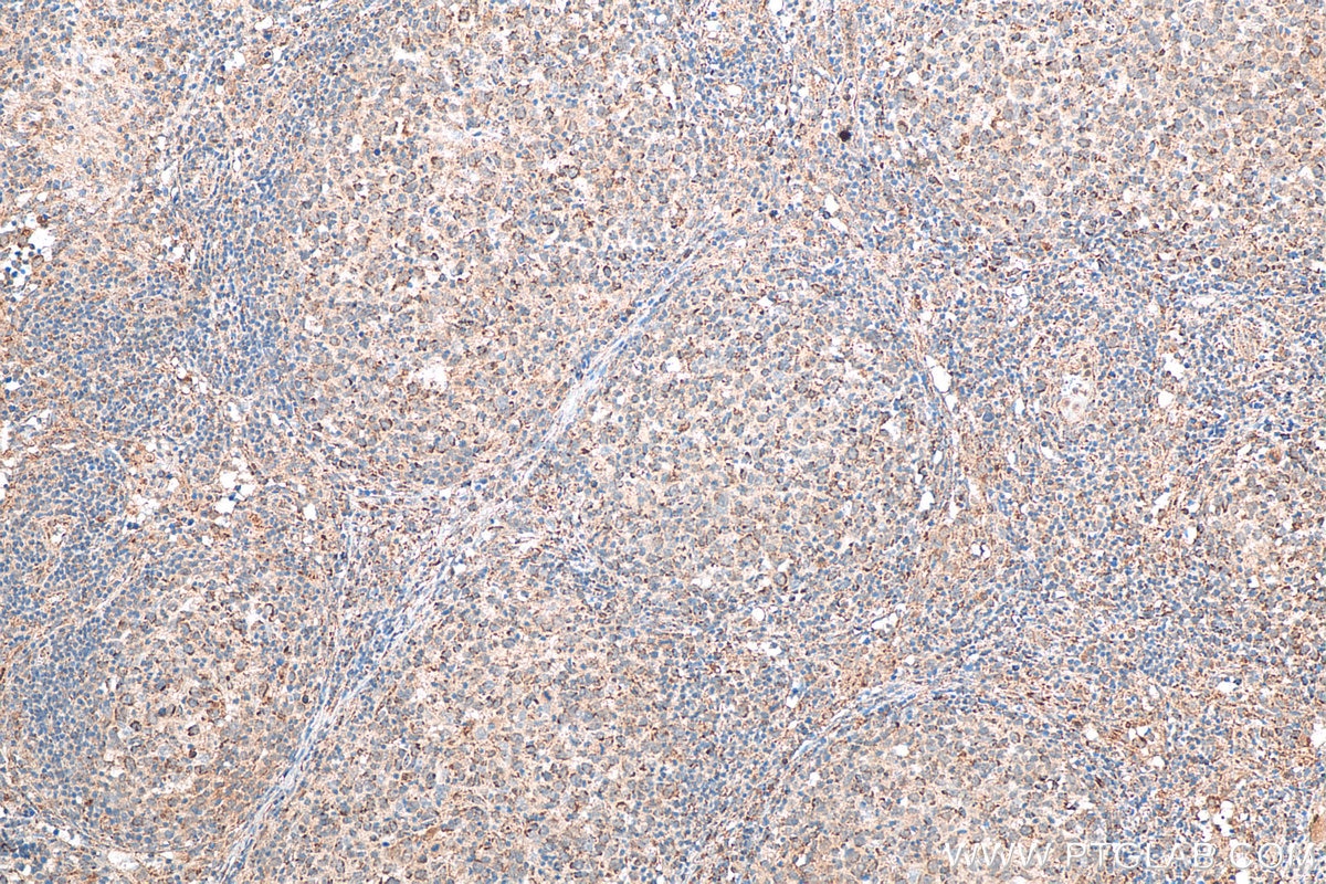 Immunohistochemistry (IHC) staining of human lymphoma tissue using JAK3 Recombinant antibody (80331-1-RR)