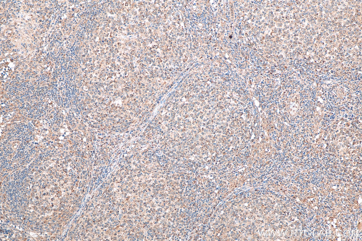 Immunohistochemistry (IHC) staining of human lymphoma tissue using JAK3 Recombinant antibody (80331-1-RR)