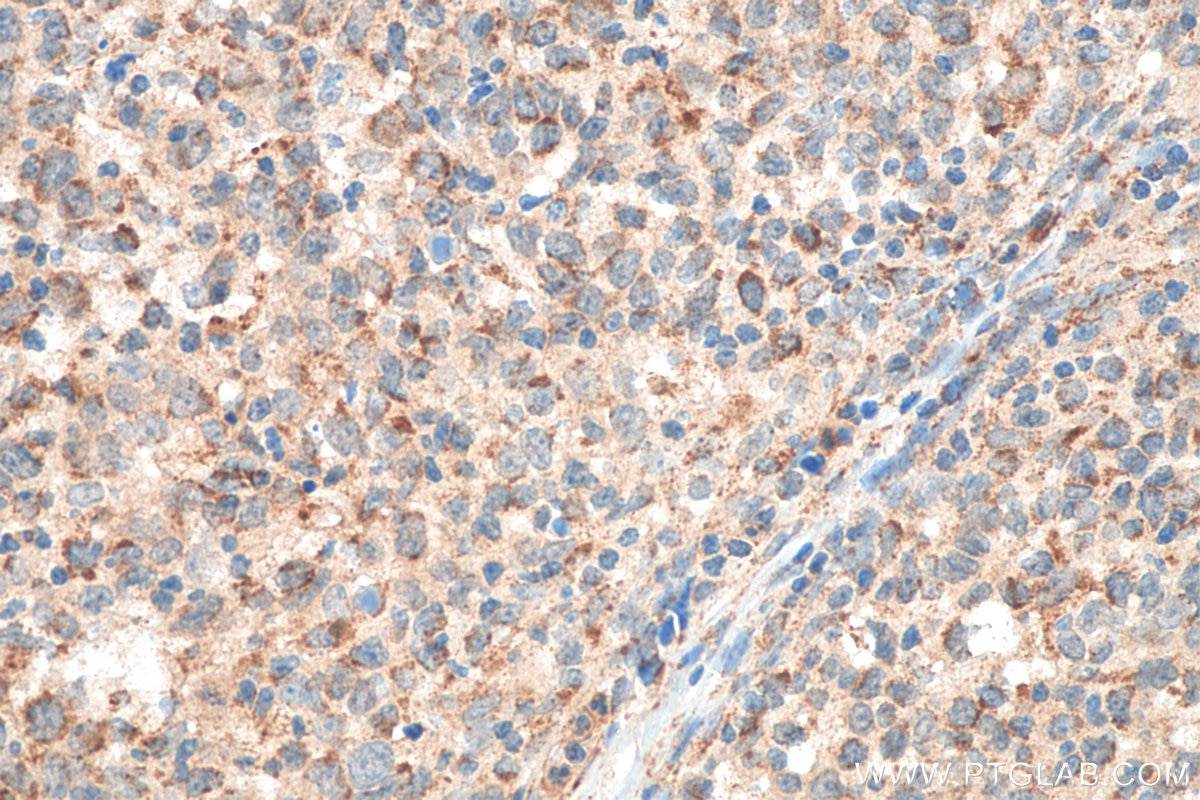Immunohistochemistry (IHC) staining of human lymphoma tissue using JAK3 Recombinant antibody (80331-1-RR)