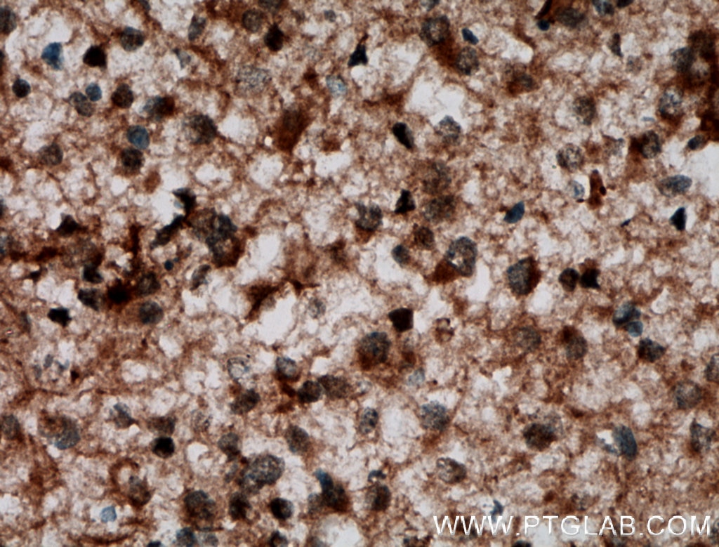 Immunohistochemistry (IHC) staining of human gliomas tissue using JAKMIP1 Polyclonal antibody (13846-1-AP)