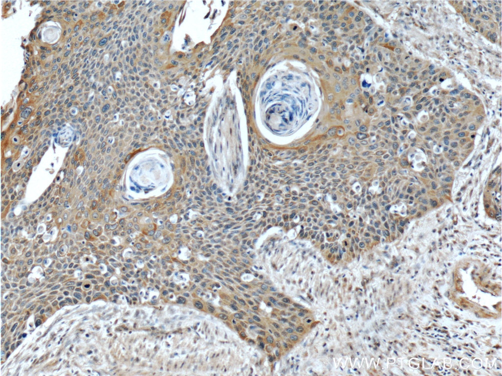 Immunohistochemistry (IHC) staining of human oesophagus cancer tissue using JIP1/IB-1 Polyclonal antibody (14568-1-AP)