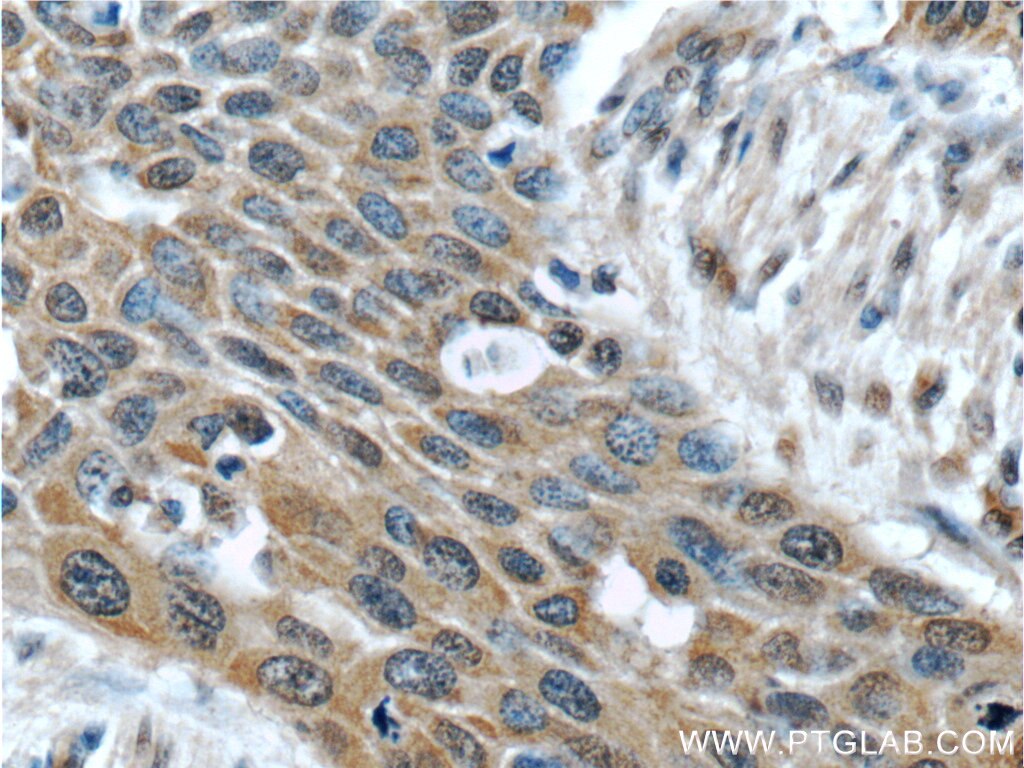 IHC staining of human oesophagus cancer using 14568-1-AP