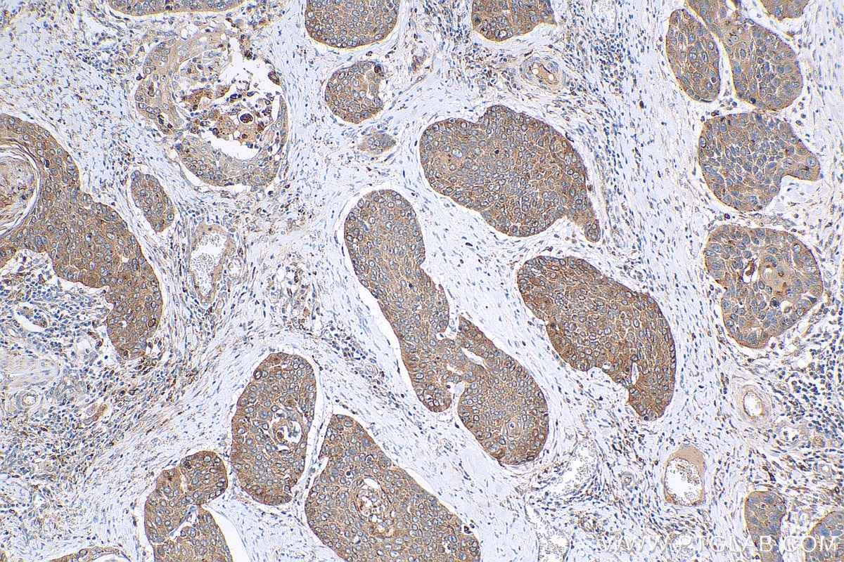 Immunohistochemistry (IHC) staining of human oesophagus cancer tissue using JIP1/IB-1 Polyclonal antibody (14568-1-AP)