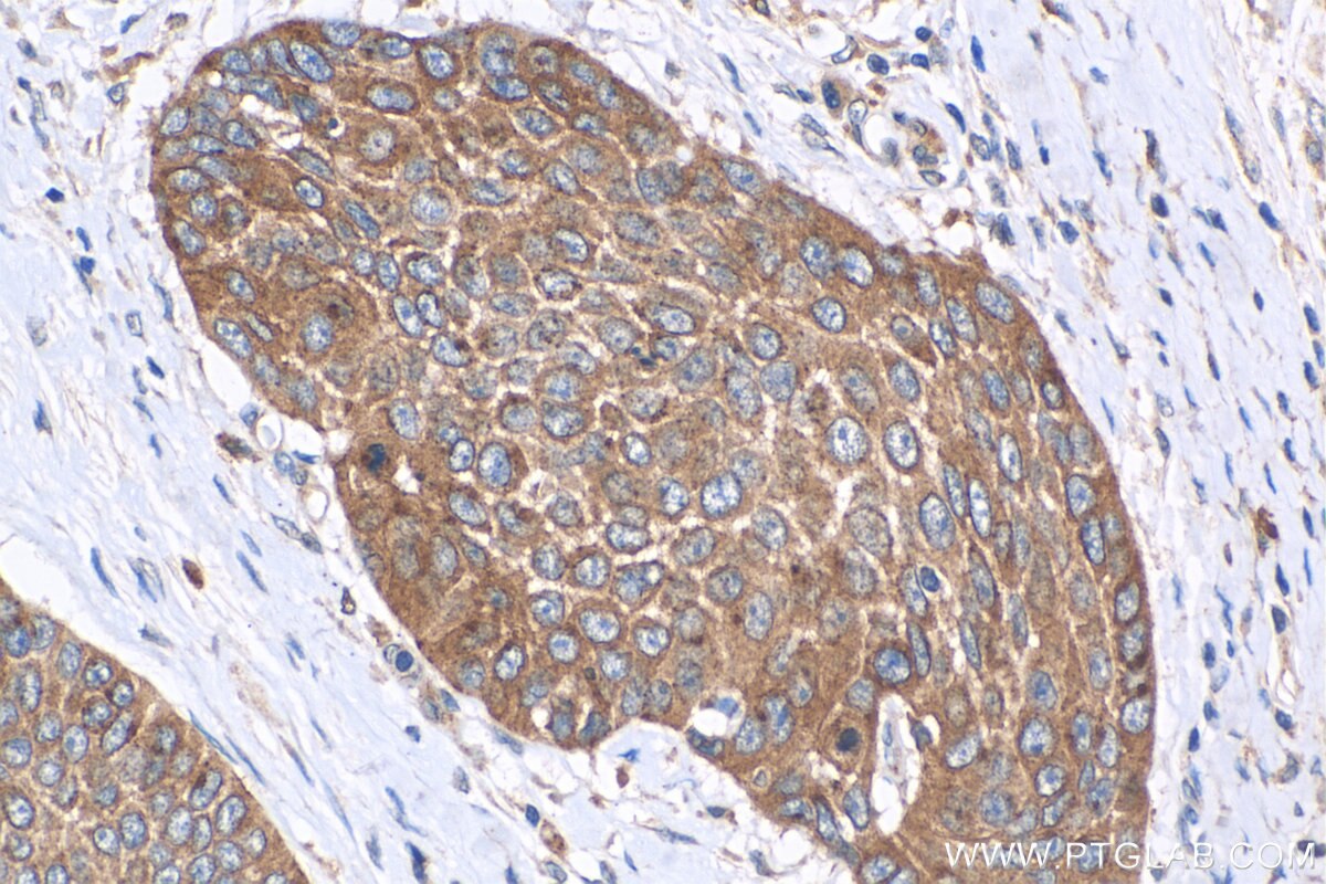 Immunohistochemistry (IHC) staining of human oesophagus cancer tissue using JIP1/IB-1 Polyclonal antibody (14568-1-AP)