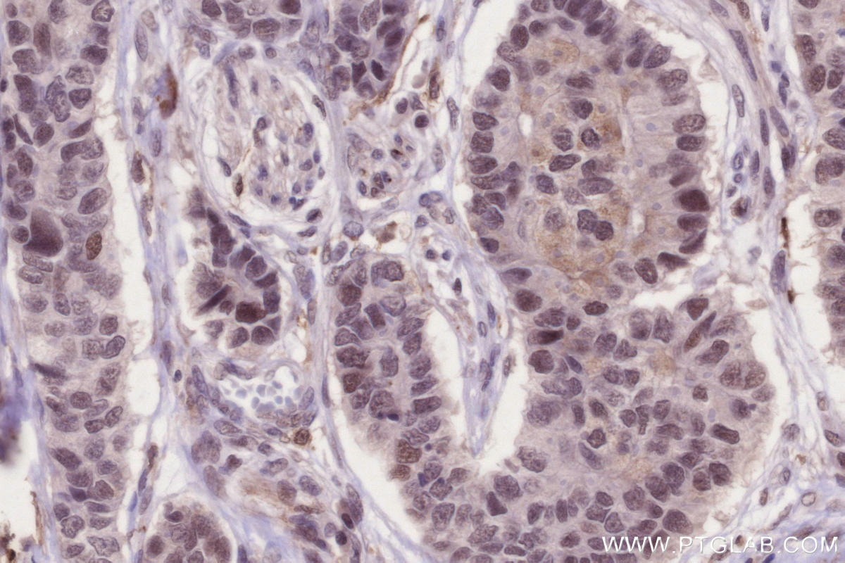 Immunohistochemistry (IHC) staining of human stomach cancer tissue using JMJD5 Recombinant monoclonal antibody (84804-4-RR)
