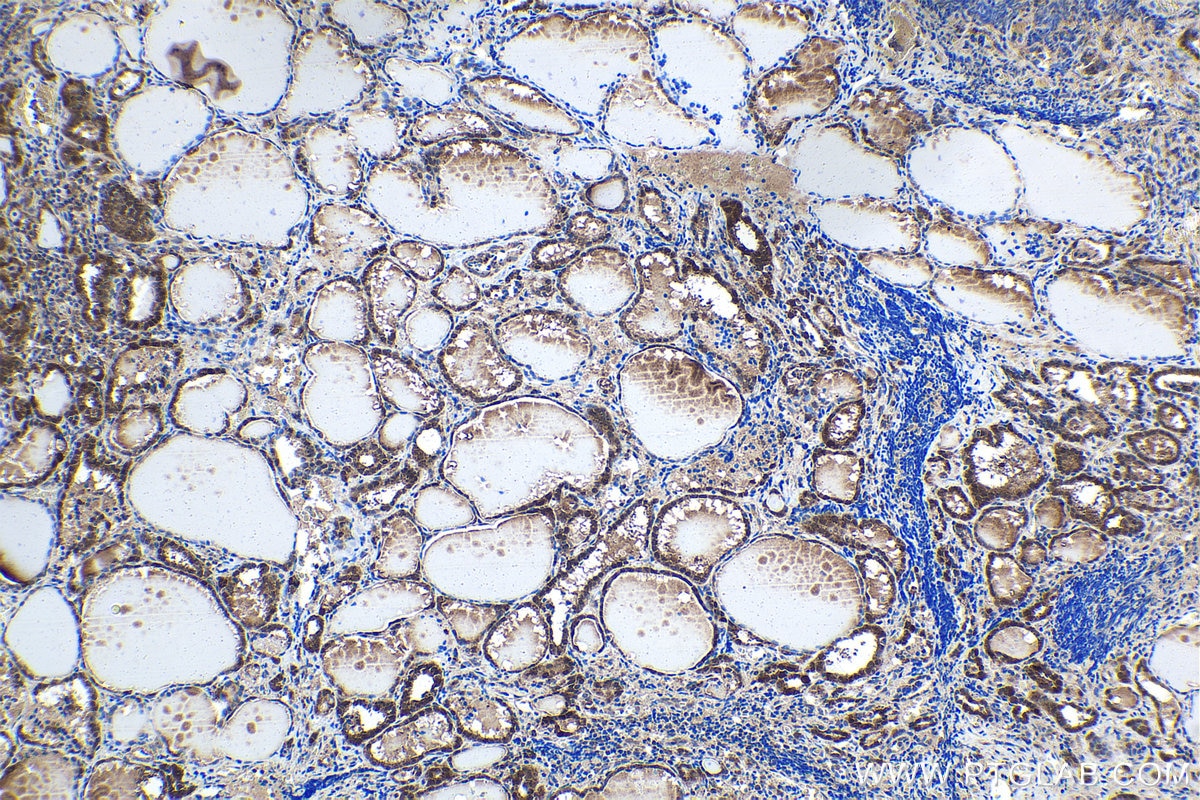 Immunohistochemistry (IHC) staining of human thyroid cancer tissue using JMJD7 Polyclonal antibody (21168-1-AP)
