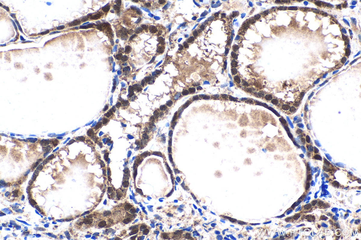 Immunohistochemistry (IHC) staining of human thyroid cancer tissue using JMJD7 Polyclonal antibody (21168-1-AP)
