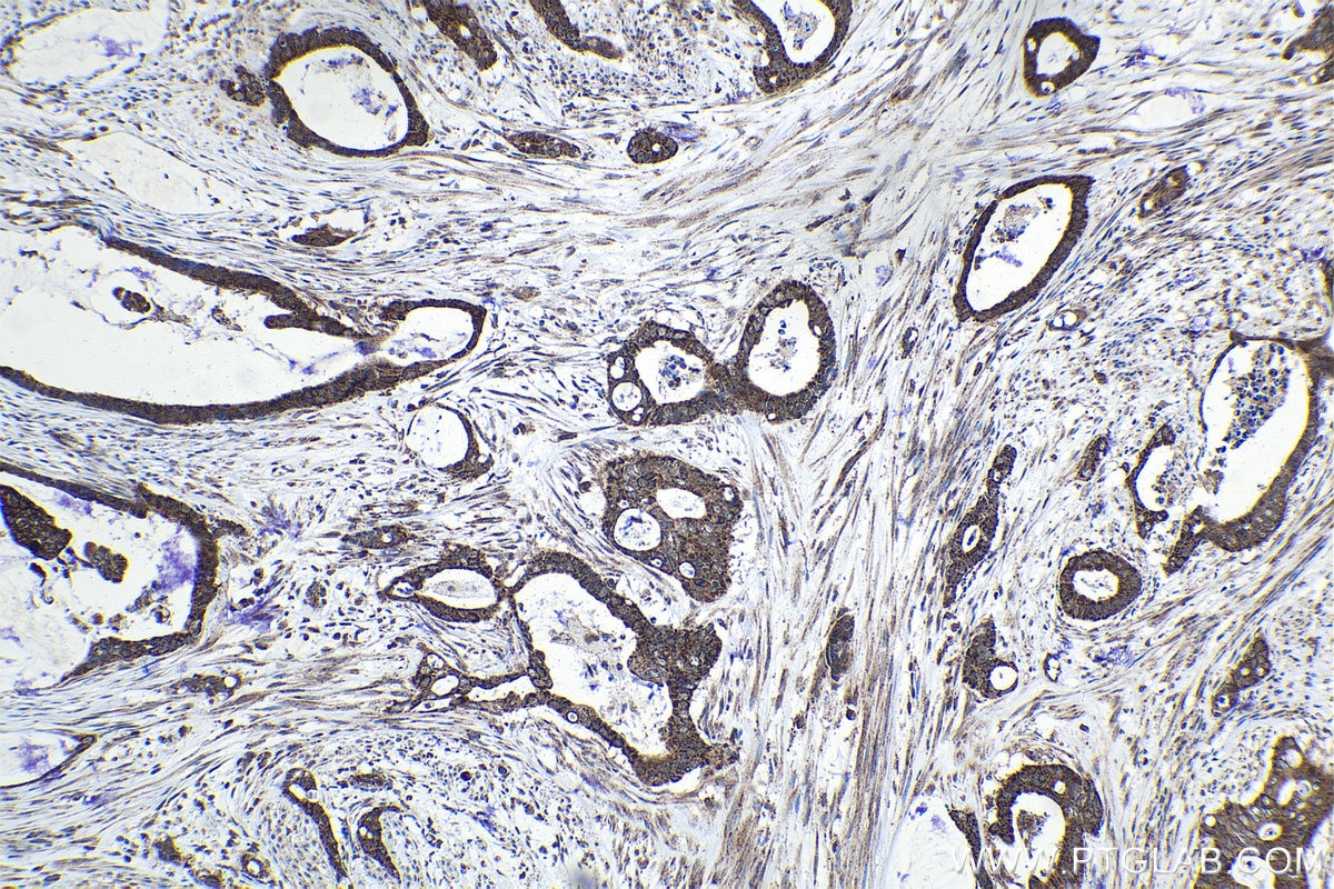Immunohistochemistry (IHC) staining of human urothelial carcinoma tissue using JMJD7 Polyclonal antibody (21168-1-AP)