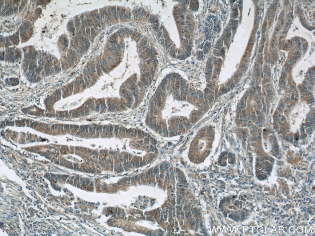 Immunohistochemistry (IHC) staining of human colon cancer tissue using JMY Polyclonal antibody (25098-1-AP)