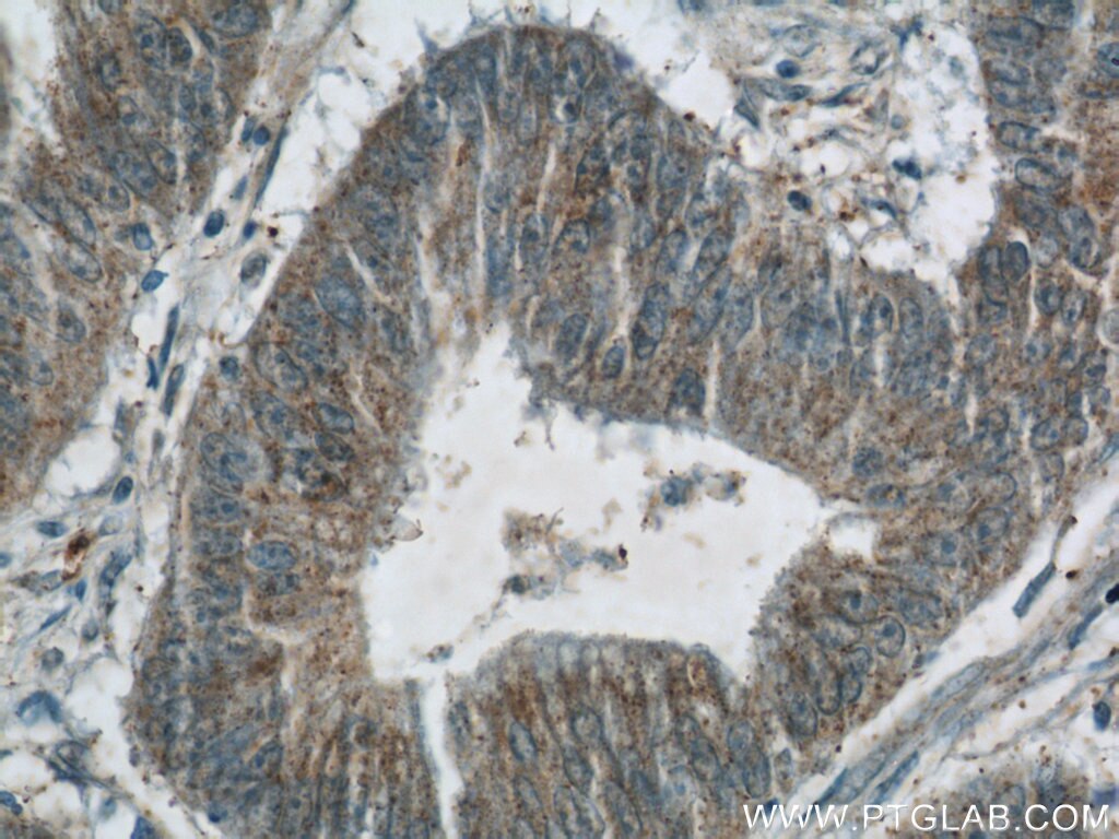 IHC staining of human colon cancer using 25098-1-AP