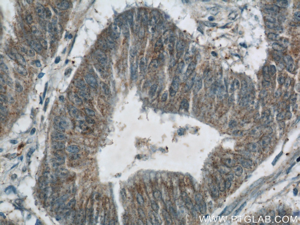 Immunohistochemistry (IHC) staining of human colon cancer tissue using JMY Polyclonal antibody (25098-1-AP)