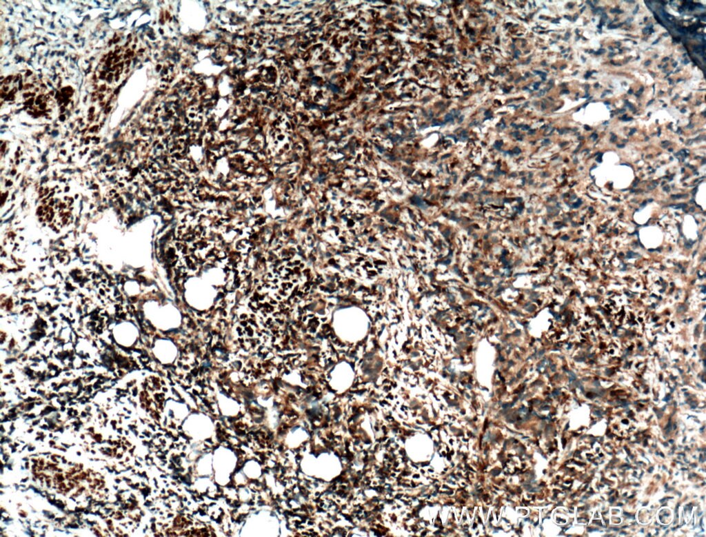 Immunohistochemistry (IHC) staining of human prostate cancer tissue using JNK Polyclonal antibody (10023-1-AP)