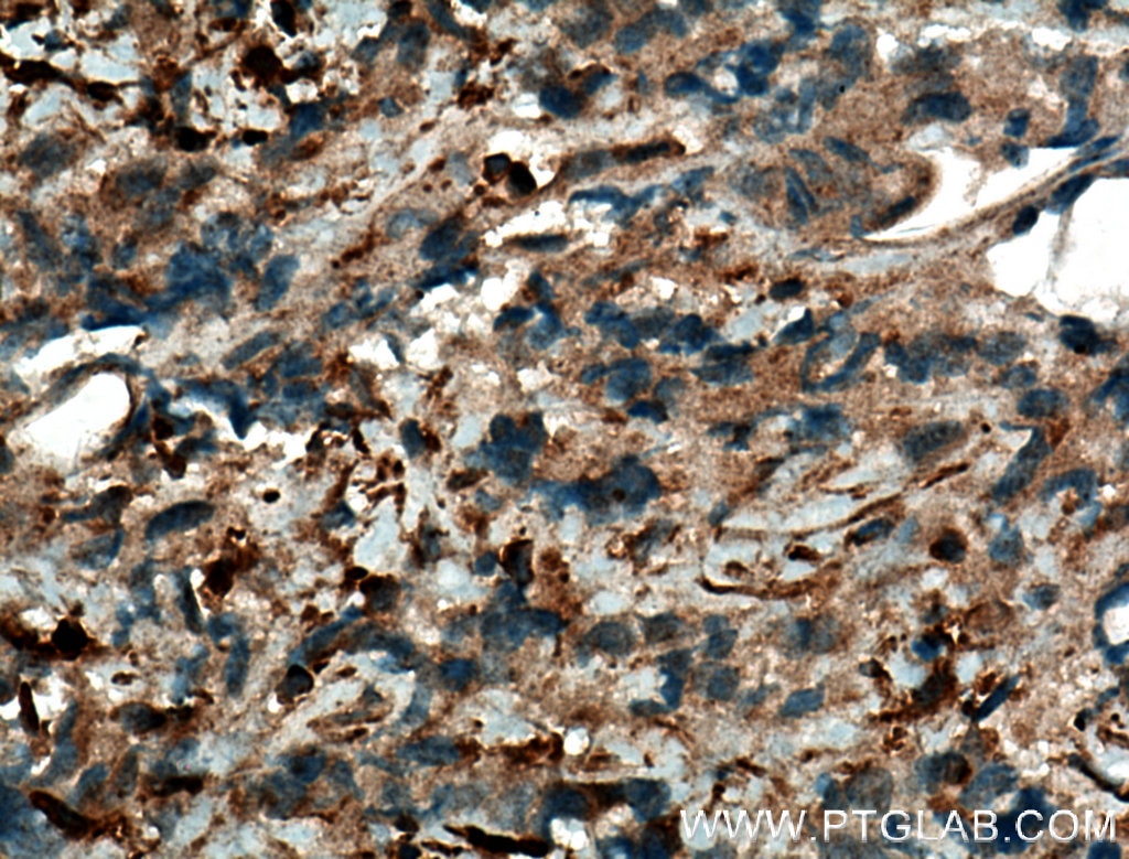Immunohistochemistry (IHC) staining of human prostate cancer tissue using JNK Polyclonal antibody (10023-1-AP)