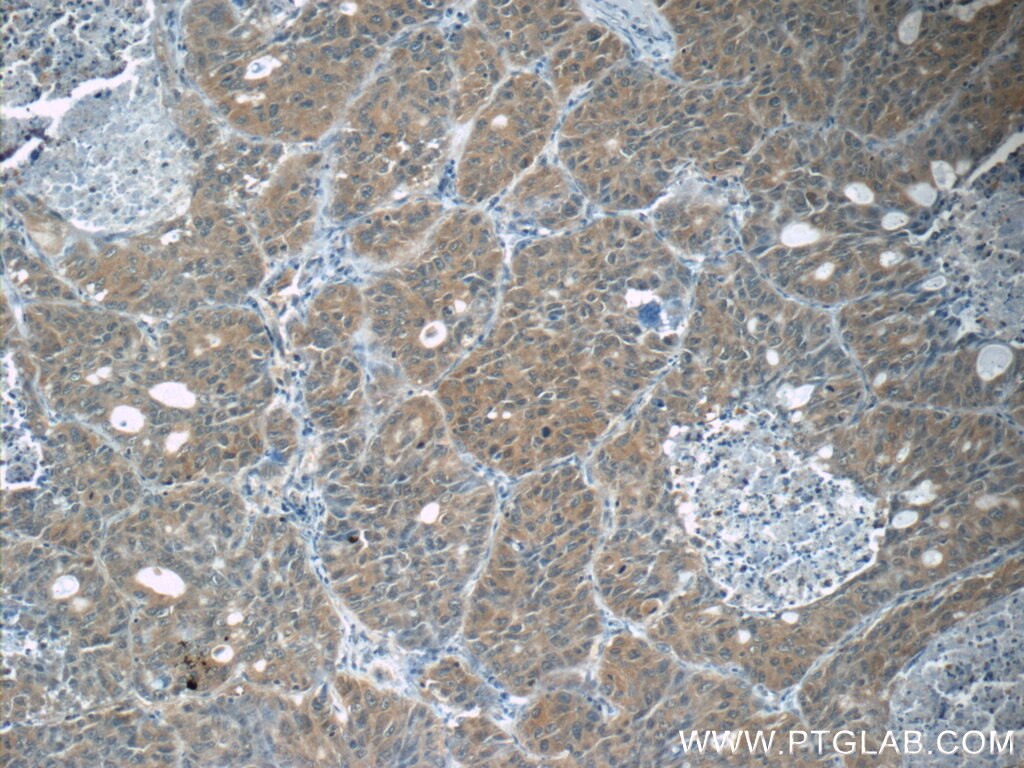 Immunohistochemistry (IHC) staining of human lung cancer tissue using JNK Polyclonal antibody (10023-1-AP)