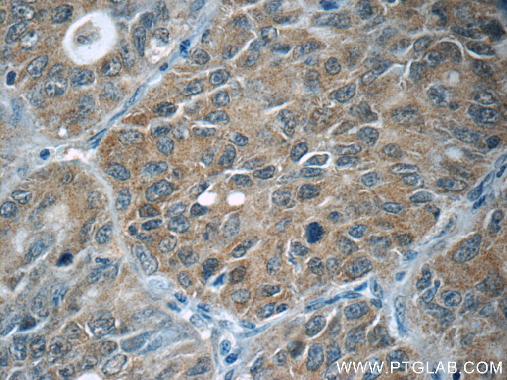 Immunohistochemistry (IHC) staining of human lung cancer tissue using JNK Polyclonal antibody (10023-1-AP)