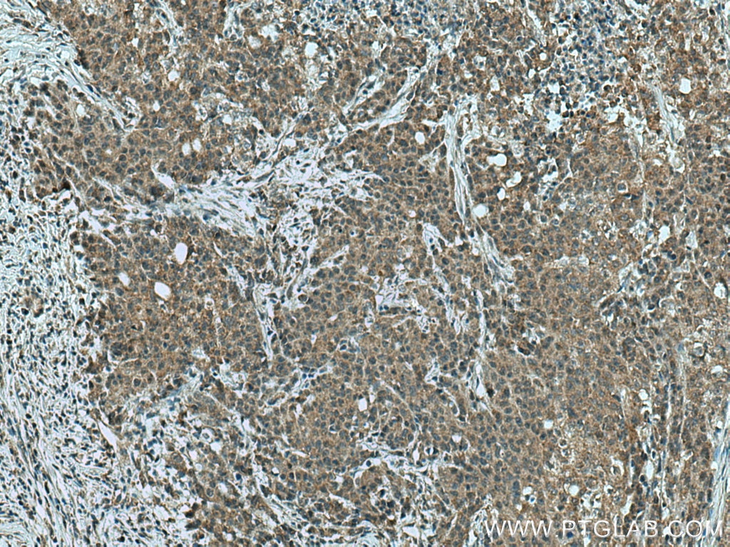 Immunohistochemistry (IHC) staining of human stomach cancer tissue using JNK Polyclonal antibody (24164-1-AP)