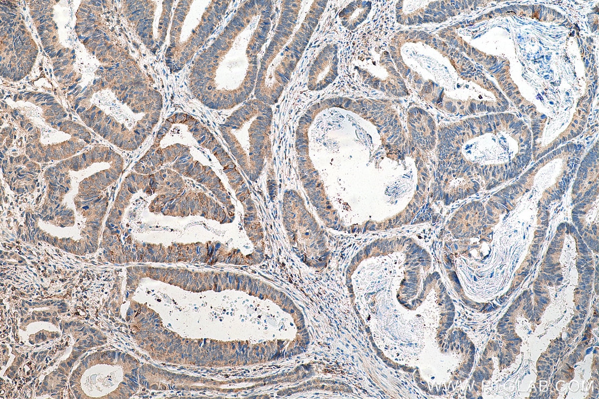 Immunohistochemistry (IHC) staining of human colon cancer tissue using JNK Polyclonal antibody (24164-1-AP)
