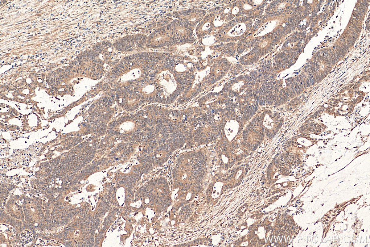 Immunohistochemistry (IHC) staining of human colon cancer tissue using JNK Polyclonal antibody (24164-1-AP)