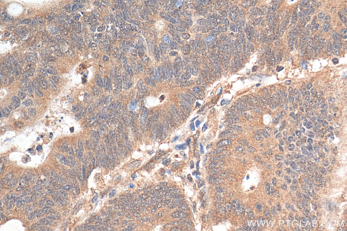 Immunohistochemistry (IHC) staining of human colon cancer tissue using JNK Polyclonal antibody (24164-1-AP)