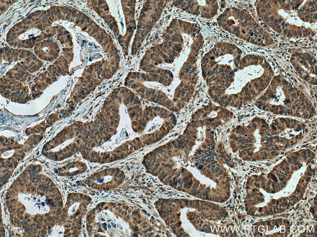 Immunohistochemistry (IHC) staining of human colon cancer tissue using JNK Polyclonal antibody (51151-1-AP)