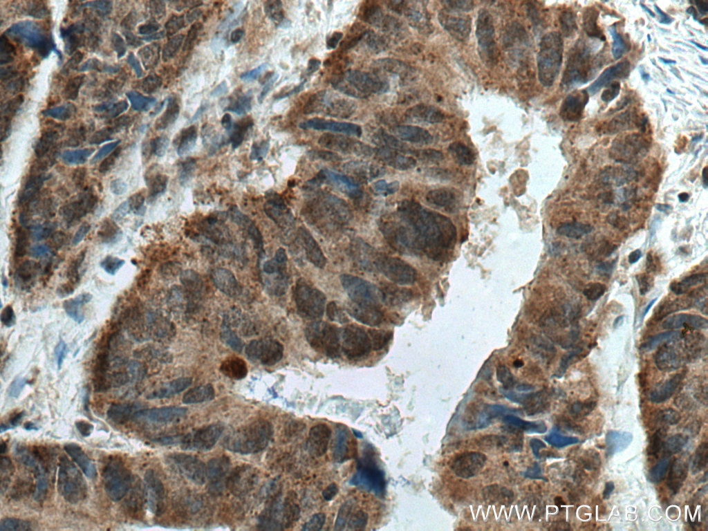 Immunohistochemistry (IHC) staining of human colon cancer tissue using JNK Polyclonal antibody (51151-1-AP)