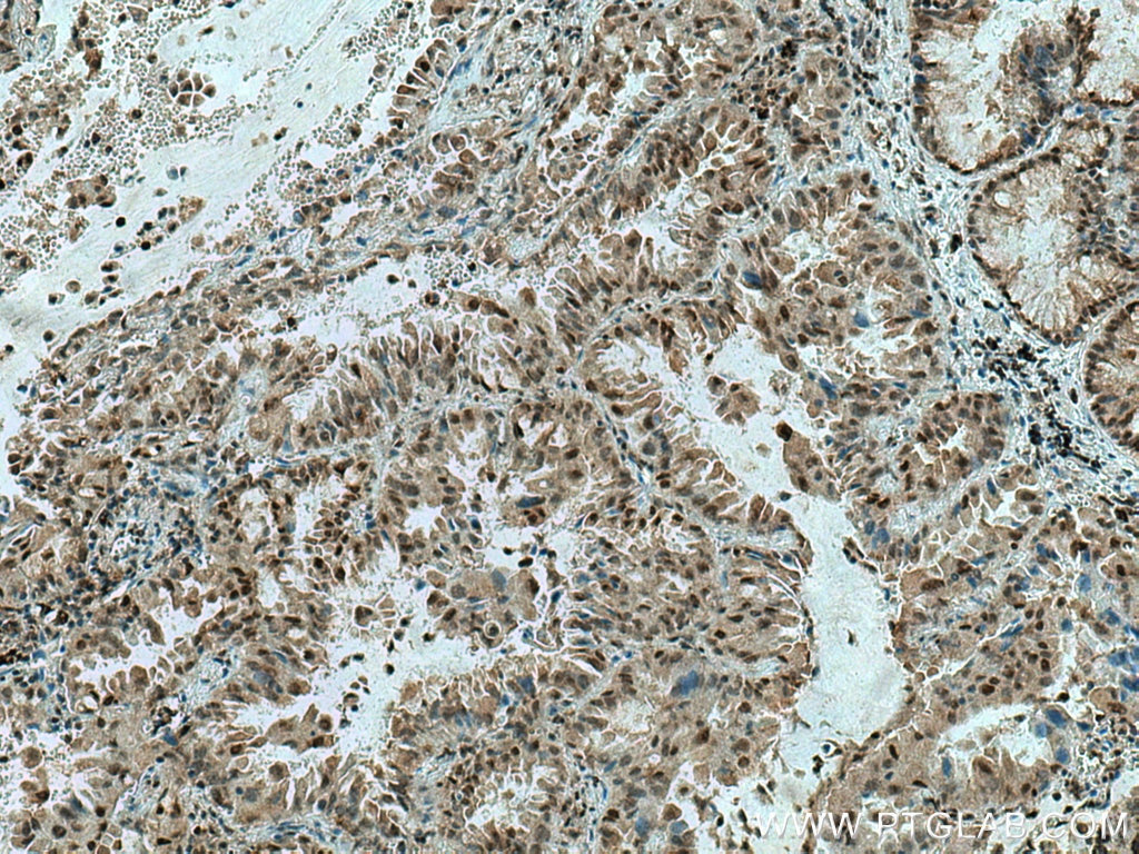 Immunohistochemistry (IHC) staining of human lung cancer tissue using JNK Polyclonal antibody (51151-1-AP)