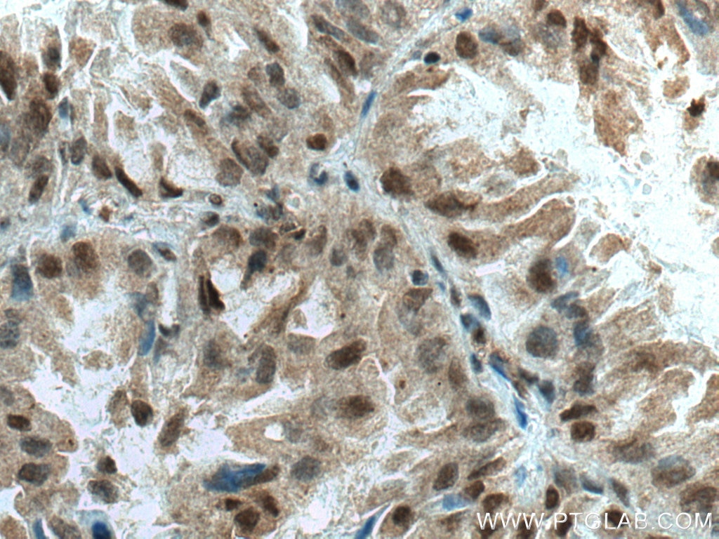 Immunohistochemistry (IHC) staining of human lung cancer tissue using JNK Polyclonal antibody (51151-1-AP)