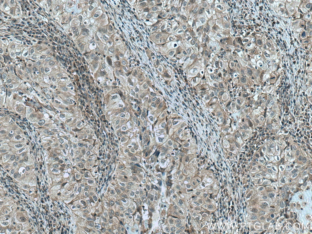 Immunohistochemistry (IHC) staining of human lung cancer tissue using JNK Monoclonal antibody (66210-1-Ig)