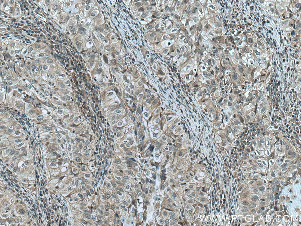 IHC staining of human lung cancer using 66210-1-Ig