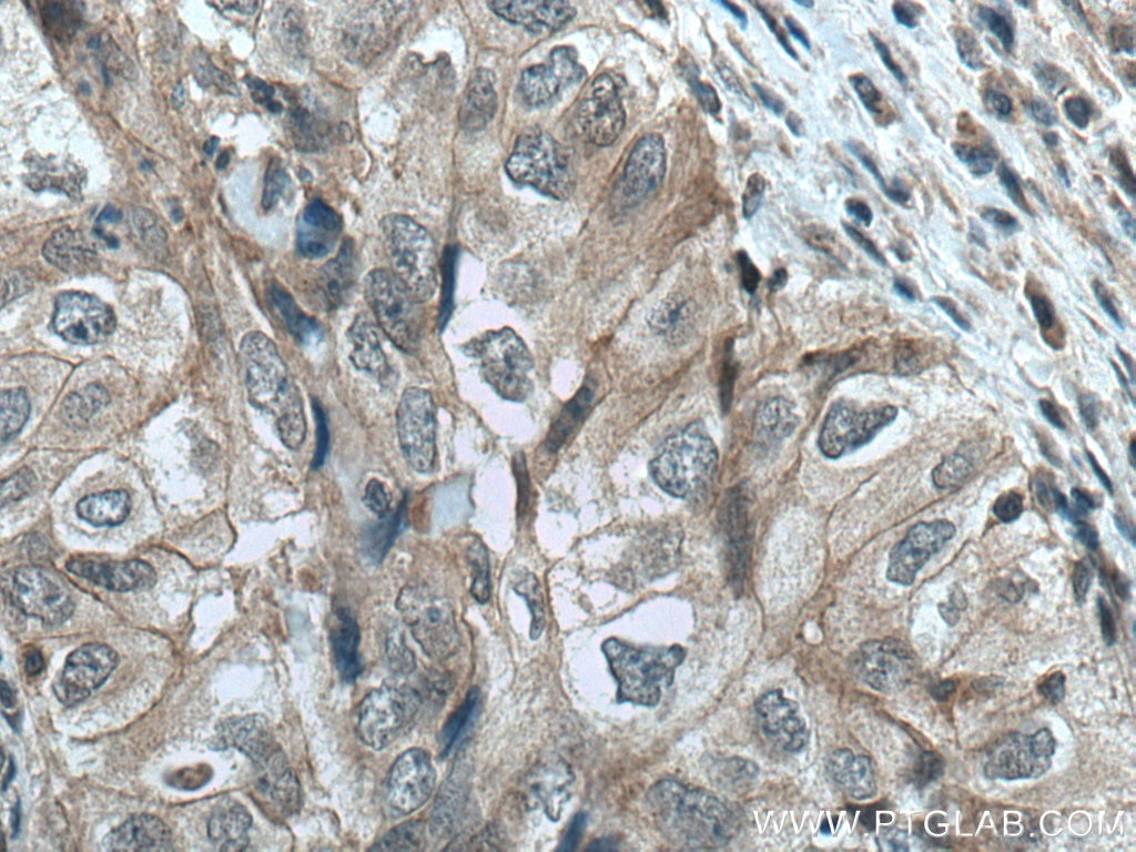 Immunohistochemistry (IHC) staining of human lung cancer tissue using JNK Monoclonal antibody (66210-1-Ig)